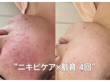 れふぇるん 足利店の雰囲気(ニキビケアはホームケアも重要!)