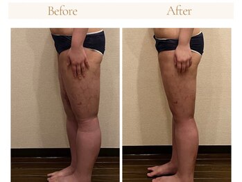 サロン タエン/術後インディバ