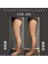 ラボラトリー バイ イー 麻布十番店(laboratory by E)/ラフォスプロ（下半身）【痩身】