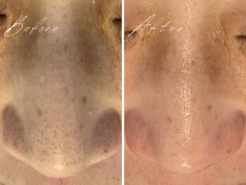 ミモア(mimoi.)/頑固な黒ずみ、角栓除去！