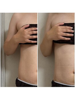 ミュウ(miuex)/産後痩身