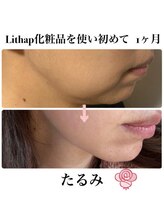 ケンビラク(Kenbiraku 健美楽)/たるみ　1か月