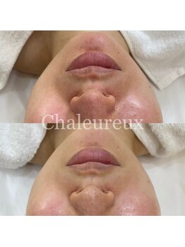 シャルル ストア 京都三条通(Chaleureux Store)/お肌悩み・赤み