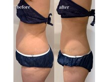 話題の脂肪燃焼剤で－5kg！運動・制限なしの本気痩せ！