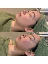リムビューティー 自由が丘(RymBeauty)/【施術後】ツヤ感・なめらか肌