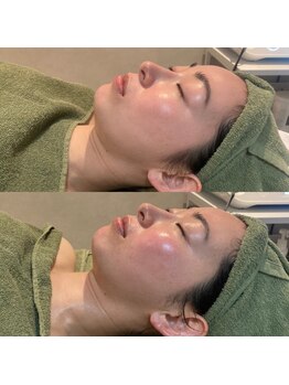 リムビューティー 自由が丘(RymBeauty)/【施術後】ツヤ感・なめらか肌