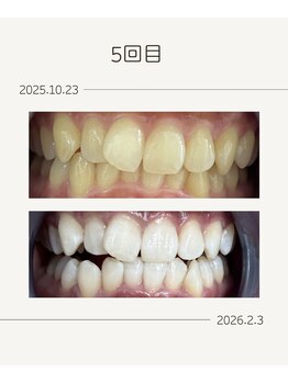 ホワイトニングショップ 福岡姪浜店/お客様before after