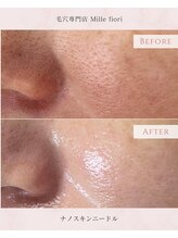 ミルフィオリ(Mille fiori)/ナノスキンマイクロニードル