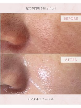 ミルフィオリ(Mille fiori)/ナノスキンマイクロニードル