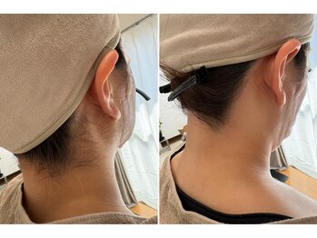 エヌクレアール(Ncrear)/うなじワックスBefore→After