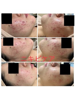 エスティ 京都店/肌荒れ改善before/after