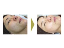 おうちサロン しゅろ/ハーブピーリング　B/A