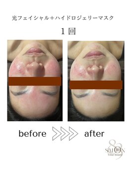 サロン エイトミー(salon 83)/光フェイシャル/before→after