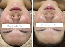 ルル(Ruru)の雰囲気(光フェイシャル+白玉泡パックBefore→After)