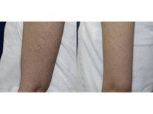 スリリアン 銀座/★お客さまビフォーアフター★