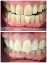 シロサロン(silo salon)/セルフホワイトニング　３回施術