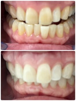 シロサロン(silo salon)/セルフホワイトニング　３回施術