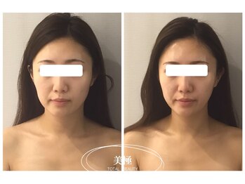 美極 銀座店/銀座/小顔コルギ/小顔矯正