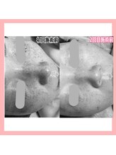 ハピネス(Hapiness)/1回の結果に驚き!最短でシミ改善