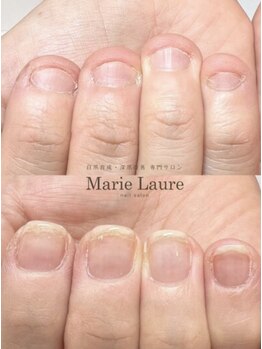 マリーロール 天王寺店(Marie Laure)/自爪育成/深爪矯正/ネイルケア