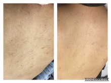 オアジスパ(Oasi Spa)/Greenpeel１回