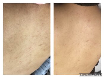 オアジスパ(Oasi Spa)/Greenpeel１回