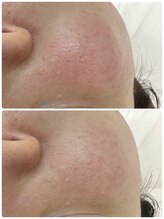 エステティック レイビス 秋田店(RAYVIS)/ＩＰＬフォト×ＩＰＬ顔脱毛