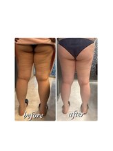 クリニカルエステ リフィーナ 西荻窪店/キャビテーション