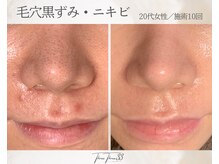 スリースリー(THREE THREE)/毛穴黒ずみ・ニキビケア