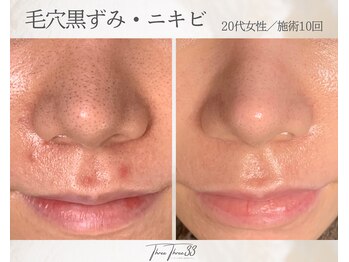 スリースリー(THREE THREE)/毛穴黒ずみ・ニキビケア