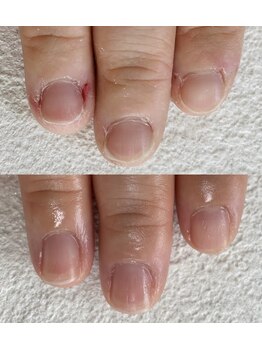 深爪改善！育成ケア