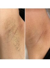 シャルム(Charme)/効果がすぐわかるワキ脱毛