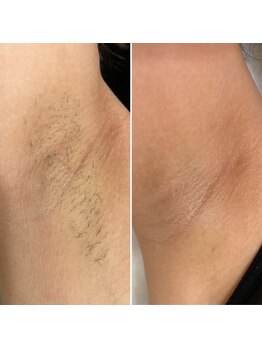 シャルム(Charme)/効果がすぐわかるワキ脱毛