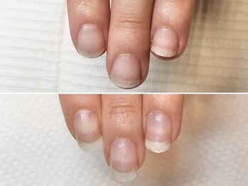 グラシュータン(gracieux temps)/深爪矯正