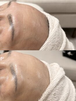 サロン ド シューナ(salon de schoner)/高周波で叶える艶とハリの額ケア