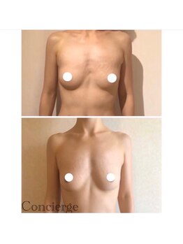 美人バスト 本厚木店/バストアップ◇症例◇