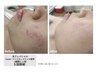 【艶肌ニキビケア】学割U24◎専用の光でニキビケア！　￥6500→￥4500