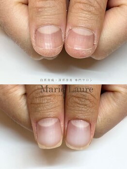 マリーロール 梅田店(Marie Laure)/自爪育成/深爪矯正/ネイルケア