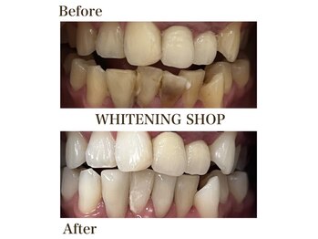 ホワイトニングショップ 明石大久保店/【BeforeAfter】