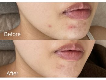 綺麗サロン 脱毛アンドフェイシャル ジュエル(Jewel)/【4BミネラルクリアTR】