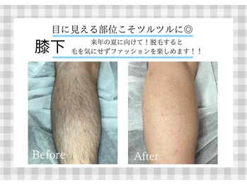 アルゴ 熊本玉名店(ALGO)/【膝下】劇的ビフォーアフター