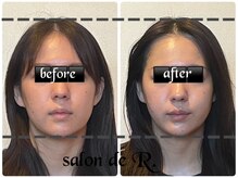 サロン ド アール(salon de R.)/【小顔骨氣・20代・施術効果】