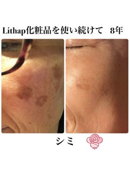 ケンビラク(Kenbiraku 健美楽)/シミケア　Lithap続けて　8年