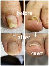 フロー(Froh)/リモートワーク　巻き爪