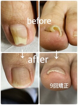 リモートワーク　巻き爪