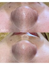 リリーラボ(LILY LAB)/毛穴洗浄症例