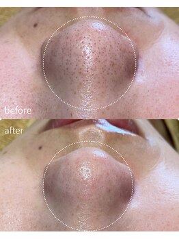 リリーラボ(LILY LAB)/毛穴洗浄症例