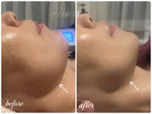 エルール トータルビューティ(Aileure total beauty)の雰囲気（【あご下肉・肌質改善・小顔】インディバ小顔矯正フェイシャル）