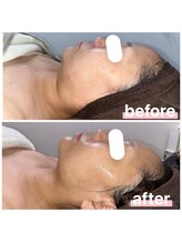 プリマ 大津店(PRIMA)/REDSHOT輪郭形成術【4回目】