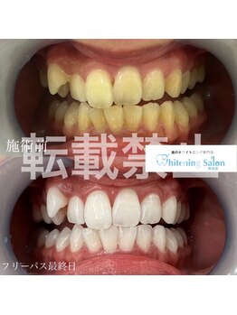 ホワイトニングサロン 熊本店の写真/【熊本・歯科提携サロン】高い実績口コミエリアTOPレベル!丁寧なカウンセリングでホワイトニング初心者◎